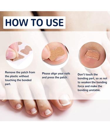 100 PCS Breathable Self-Adhesive Toenail Correction Patch - Ingrown Toenail Corrector Stickers Blue - Buy Online on GoSupps.com