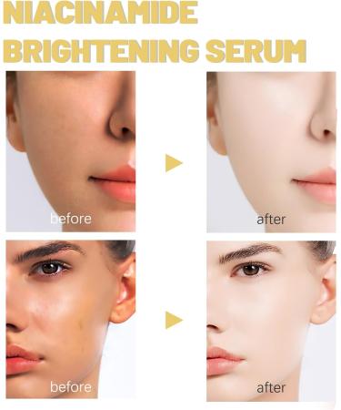 Niacinamide Brightening Serum Control Excess Oil And Redness Face Serum Tackles Blemishes Minimise Pores Anti Aging Hyaluronic Acid Serum Face Dark Spot Remove Moisturiser - Buy Online on GoSupps.com