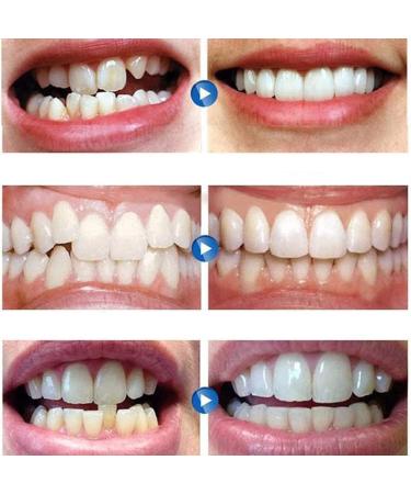 Buy XZLZMD Silica Gel Dentures - Reusable Upper & Lower Veneers for a Perfect Smile | Unisex | 5 Pairs - International Shipping Available - Buy Online on GoSupps.com