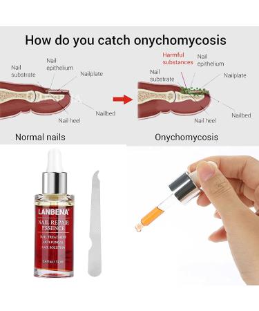 Nail Repair Essence 12ml - Natural Anti-fungus Treatment for Effective Nail Repair - Buy Online on GoSupps.com