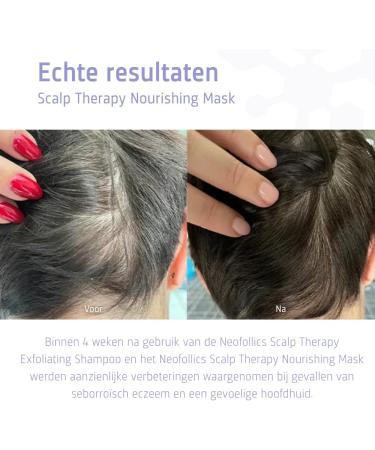 Neofollics Hair Technology Neofollics Scalp Therapy Nourishing Mask Scalp Mask Nongreasy leavein mask against dandruff seborrheic eczema and psoriasis Soothes itching and flaking 175 ml - Buy Online on GoSupps.com