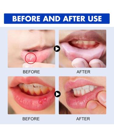 Mouth Ulcer Spray - 30ml Antibacterial Relief for Mouth Wounds & Soothing Care - Buy Online on GoSupps.com