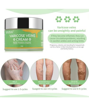 Veins Relief Cream for Fast Angiitis & Phlebitis in Knee & Legs - 3 Boxes | Varicose & Spider Veins Treatment Ointment | 6.5x6.5x5.2cm x 3pcs - Buy Online on GoSupps.com