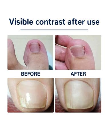 Toenail Correction Patch 100PCS - Professional Ingrown Toenail Corrector Strips for Foot Care - Health Toenail Treatment Tool for Glue-Free Nail Correction - Blue - Buy Online on GoSupps.com