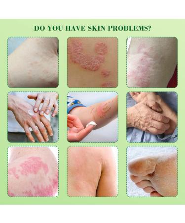 Buy Anti-Itch Cream | Herbal Antibacterial Eczema Treatment for Allergic Dermatitis - Ships Worldwide - Buy Online on GoSupps.com