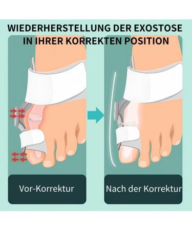 Adjustable Hallux Valgus Correction Rail for Big Toe Straightening - Unisex Day & Night Relief | Comfortable & Effective Solution - Buy Online on GoSupps.com
