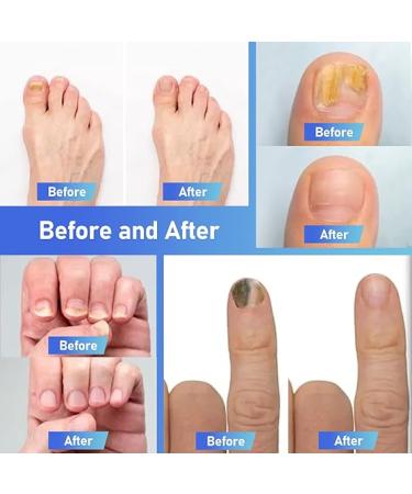 XIFEPFR Toenail Repair Pen - Nail Fingernail Repair Pen for Thick  Broken  Discolored Nails - Restores Healthy Strong Nails - 4PCS - Buy Online on GoSupps.com