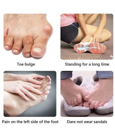 Urisgo Hallux Valgus Correction: Orthopedic Bunion Rail for Great Toe Pain Relief & Support - 2 Pieces for Day/Night Use - Buy Online on GoSupps.com