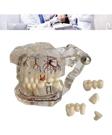Model of Tooth Disorders Transparent Adult Teeth Dental Model of Teeth Tooth Removable Prosthetics Teeth Demonstration Model for Teaching Transparent - Buy Online on GoSupps.com