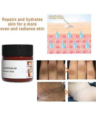 Anshka AcanthoGlow Therapy Cream Dark Knuckles Whitening Serum Dark Spot Corrector Oil Dark Knees and Elbows Strong Whitening Cream Body Black Skin 3 pieces - Buy Online on GoSupps.com