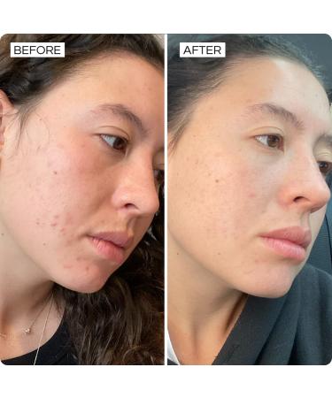 SONYA DAKAR Super Clear Serum - Acne Fighting with Salicylic Acid & Niacinamide | Minimize Pores Reduce Inflammation & Blemishes | International Shipping Available - Buy Online on GoSupps.com