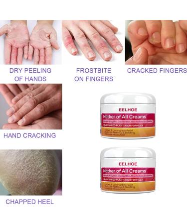 2 Chapped Cream Face Hydrating Moisturizer Moisture Cream for Face Foot Moisturizer Foot Cream Dead Skin Cream Exfoliator Cream Anti Drying Cream Abs Body Lotion Moisturizing - Buy Online on GoSupps.com