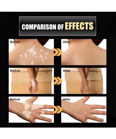 Alkyne Vitiligo Removal Relief Spray - Skin Repair & Treatment for Vitiligo Care (1pc) - Buy Online on GoSupps.com