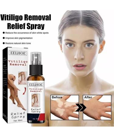 Alkyne Vitiligo Removal Relief Spray - Skin Repair & Treatment for Vitiligo Care (1pc) - Buy Online on GoSupps.com