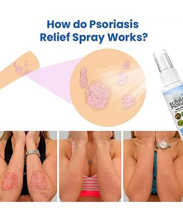 Dubush 30ml Herbal Psoriasis Relief Spray - Natural Eczema & Psoriasis Treatment - Soothing Moisturizing Mist - Set of 3 - Buy Online on GoSupps.com