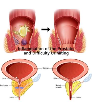 Koconh Heca Natural Herbal Hemorrhoid Relief Capsules - 2 Boxes | Soothes Itching, Burning & Pain - Buy Online on GoSupps.com