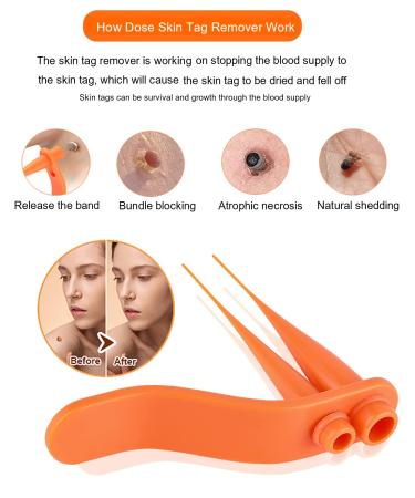 Skin Tag Removal Device Kit for Small to Large Skin Tags (2mm to 7mm) - 2-in-1 Remover Tool with Repair Patches, Removal Bands, and Cleansing Wipes - Buy Online on GoSupps.com