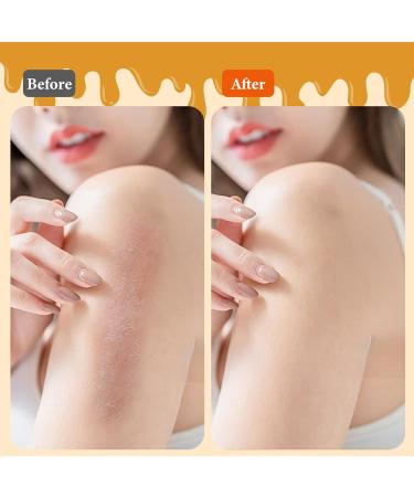 Bee Venom & Manuka Honey Ointment | Fast Acting Relief for Jock Itch Eczema Psoriasis & More - Natural Soothing Solution for Skin Rashes & Dryness - Buy Online on GoSupps.com