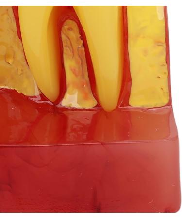 Dental Implant Model - 4x Enlargement Crown Bridge Demo Model for Recovery Effect Comparison | International Shipping Available - Buy Online on GoSupps.com