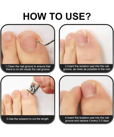 Foot Nail Correctors Corrector Strips for Ingrown Nails 50 Plasters for Toenails Toenail Correction Correction Kit for Thick Plastic Nails - Buy Online on GoSupps.com