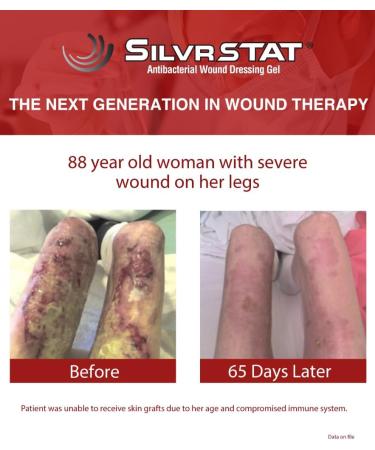 First Aid Kit Gel - 32 PPM Silver Healing Wound Dressing | SilverSol Ag O | 3 oz | International Shipping - Buy Online on GoSupps.com