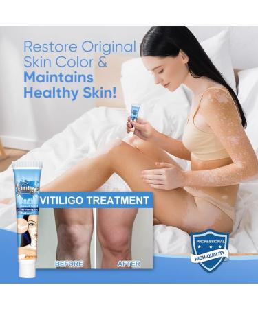 Vitiligo Cream for Skin Treatment and Pigmentation Care - Buy Online on GoSupps.com