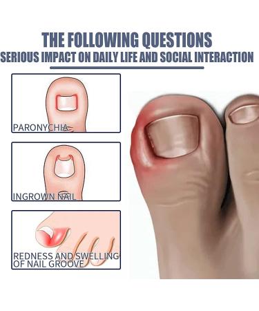 Ingrown Toenail Treatment Nail Helper Nail Growth Treatment Ingrowing Toenail Treatment Ingrown Toenail Corrector Treatment For Ingrown Toenail Ingrowing Toenail Cuticle Oil Nail Growth Treatment - Buy Online on GoSupps.com