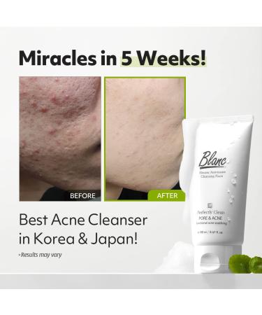 Saint Blanc Acne Treatment Face Wash 5.2 oz - Green Tea & Teatree Oil Pore Cleanser for Redness & Blackheads - Buy Online on GoSupps.com