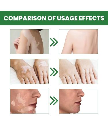 Vitiligo Fix Revitalize Elixir Cream | Psoriasis Relief | Moisturizer for Skin | Reduce White Spots | 3pcs Set - Buy Online on GoSupps.com