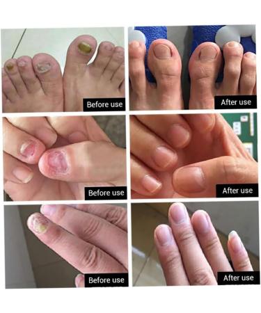 1PC Nail Treatment Nail Renewal Solution Toenails & Fingernails Nail Repairs Essential Oil Protects From Discoloration Brittle And Cracked Nail(12ML)  - Buy Online on GoSupps.com