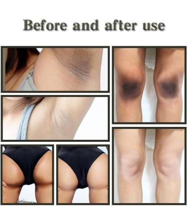 Acanthosis Nigricans Treatment Bamboo Charcoal Soap Activated Charcoal Black Bar Soap Dark Spot Remover Soaps Suitable for Any Part (3 pcs) - Buy Online on GoSupps.com