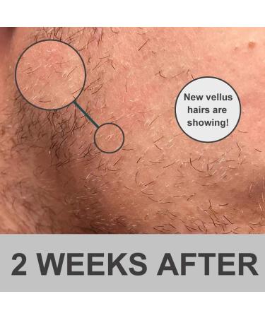 OCHILIMA Beard Growth Kit: 0.5mm Derma Roller & Beard Oil for Men - Promote Facial Hair Growth and Grooming Tool for New and Old Hair Growth - Buy Online on GoSupps.com