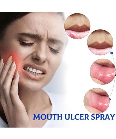 Mouth Spray for Soothing Relief | Mouth Ulcer & Sores Care | International Shipping - Buy Online on GoSupps.com