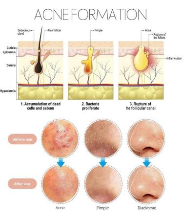 Blackhead Pimple Comedone Spot Acne Extractor/Remover Kit Popper Tools - Buy Online on GoSupps.com