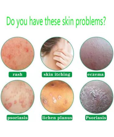 Natural Herbal Eczema & Psoriasis Repair Cream - Anti-Itch Relief for Dry, Red, and Rough Skin - 0.7 oz - Buy Online on GoSupps.com