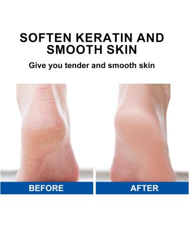 42% Urea Cream with 2% Salicylic Acid- Urea Cream for Feet - Foot Cream for Dry Cracked Heels and Feet - Callus Remover Gel Foot Lotion - Moisturizing & Smoothing Skin - For Elbows Hands and Knees - Buy Online on GoSupps.com
