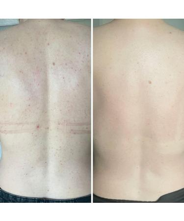 Australian Bodycare Salicylic acid spray against pimples impure skin and clogged pores with 2 salicylic acid and glycolic acid for deep cleansing of the pores - Buy Online on GoSupps.com