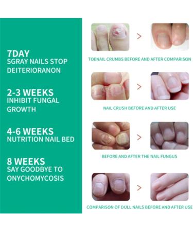 Fungus Treatment Oil Foot Fungus Oil Kerasentials Nail Treatment Healthy Natural Repair Nails Natural Toenail for Damaged & Discolored Toe Nails (2pcs) - Buy Online on GoSupps.com