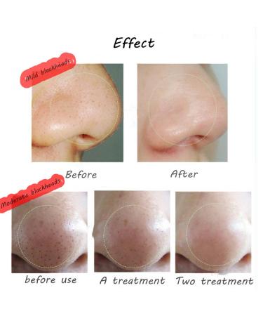 Thailand Blackhead Remover Cream - Deep Cleansing for Pores, Acne, and Pimples - 1 Box - Buy Online on GoSupps.com