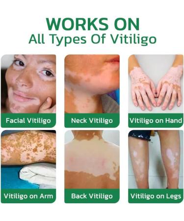 GFOUK Vitiligo Treatment Cream - Soothing White Spot & Psoriasis Relief (2pcs) - Buy Online on GoSupps.com