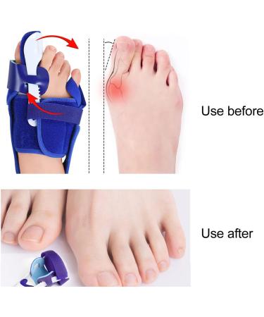 Bunion Toe Splint - Soft Fabric, Prevent Deviation, Daily Use (Right) - Buy Online on GoSupps.com