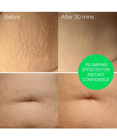 MULTI-AWARD-WINNING Stretch Marks Removal for Men & Women Peptide and Vitamins Stretch Mark & Scar Cream for Reduction in Stretch Marks Improves Elasticity and Firmness Perfect Pregnancy Gift STRETCH MARKS REMOVAL CREAM - Buy Online on GoSupps.com