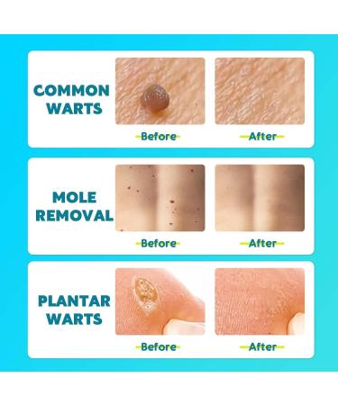 Solution anti-verrues limine rapidement les excroissances cutan es et les grains de beaut . Kit d'ampoules anti-verrues doux et sans cicatrices convient tous les types de peau - Buy Online on GoSupps.com