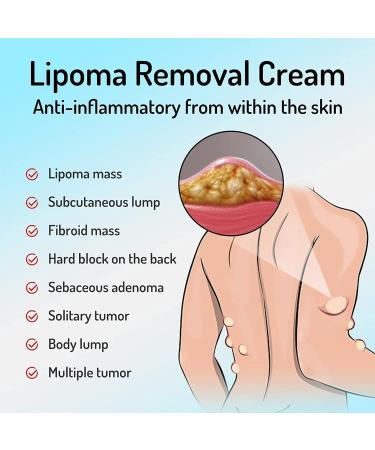 Lipoma Removal Cream Cr me d' limination de lipomes Cellulite Removal Exfoliating Cream Get Rid of Your Fatty Lipoma Lumps (2pcs) - Buy Online on GoSupps.com