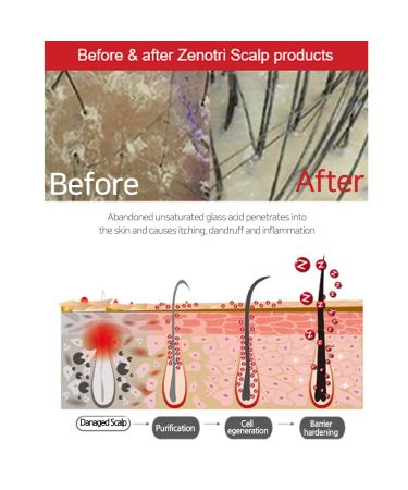 ZENOTRI Scalp Essence 25ml - Scalp Acne & Itching Treatment | Seborrheic Dermatitis Cure Cream | Soothes Damaged Scalp - Buy Online on GoSupps.com