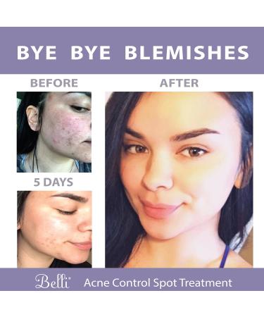 Belli Skincare Acne Control Spot Treatment 0.5 fl oz - Target Breakouts Effectively - Buy Online on GoSupps.com