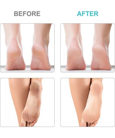 CLYWENSS 6-Pack Replacement Heads for Finishing Touch Flawless Pedi Electric Tool - 3 Black Coarse + 3 Gray Fine Refills | As Seen on TV - Buy Online on GoSupps.com