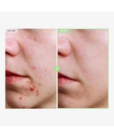 NATUREKIND Acne Deep Cleansing Foam, Formulated with Salicylic Acid for Acne Prone Skin, Daily Acne Face Wash for Removing Sebum and Dead Cells, Korean Skin Care, 100ml, 3.38 fl. oz. - Buy Online on GoSupps.com