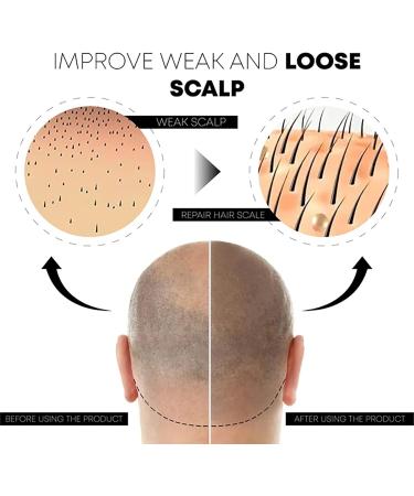 ATTDX Scalp Folliculitis Relief Oil GFOUK Scalp Folliculitis Treatment Oil Natural Remedies Nourishing Oil for All Hair Types - Buy Online on GoSupps.com