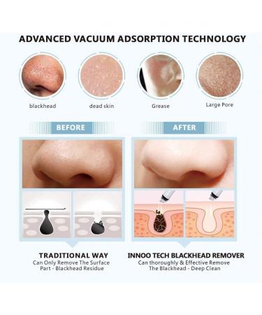 Bleackhead Remover Vacuum- Facial Cleanser Electric Acne Comedone 3 Adjustable Suction Power Blackhead Extractor Tool USB Rechargeable with LED Display for All Skin Treatment - Buy Online on GoSupps.com